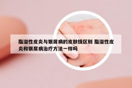 脂溢性皮炎与银屑病的皮肤镜区别 脂溢性皮炎和银屑病治疗方法一样吗