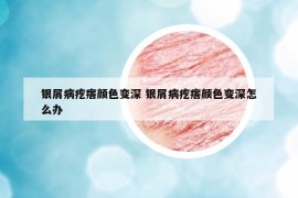 银屑病疙瘩颜色变深 银屑病疙瘩颜色变深怎么办
