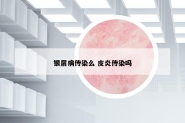 银屑病传染么 皮炎传染吗