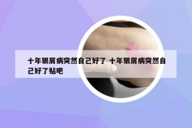 十年银屑病突然自己好了 十年银屑病突然自己好了贴吧