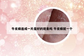 牛皮癣连成一片是好的现象吗 牛皮癣就一个