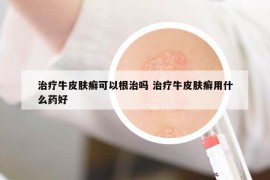 治疗牛皮肤癣可以根治吗 治疗牛皮肤癣用什么药好