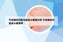 牛皮癣吃药能引起血小板减少吗 牛皮癣会引起血小板低吗