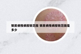 银屑病慢病报销范围 银屑病慢病报销范围是多少