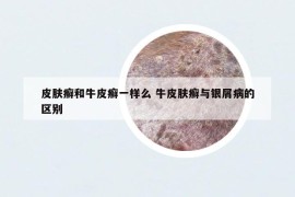 皮肤癣和牛皮癣一样么 牛皮肤癣与银屑病的区别