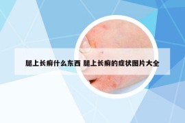 腿上长癣什么东西 腿上长癣的症状图片大全