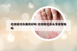 吃核桃对白癜风好吗 吃核桃对白头发有帮助吗