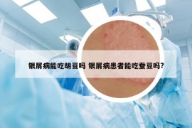 银屑病能吃胡豆吗 银屑病患者能吃蚕豆吗?