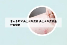 本人今年30头上长牛皮癣 头上长牛皮癣是什么症状
