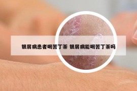 银屑病患者喝苦丁茶 银屑病能喝苦丁茶吗