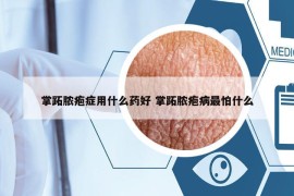 掌跖脓疱症用什么药好 掌跖脓疱病最怕什么