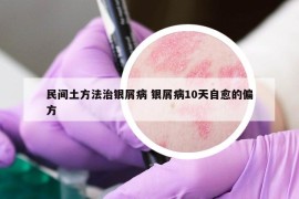 民间土方法治银屑病 银屑病10天自愈的偏方