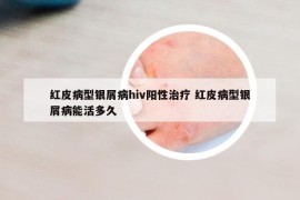 红皮病型银屑病hiv阳性治疗 红皮病型银屑病能活多久