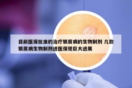 目前医保批准的治疗银屑病的生物制剂 几款银屑病生物制剂进医保现巨大进展