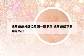 银屑病病损部位周围一圈黑色 银屑病留下黑印怎么办