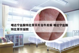 唯达宁盐酸特比萘芬片治牛皮癣 唯达宁盐酸特比萘芬凝胶