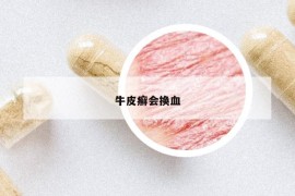 牛皮癣会换血