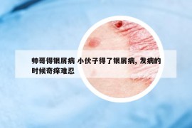 帅哥得银屑病 小伙子得了银屑病, 发病的时候奇痒难忍