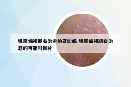 银屑病初期有治愈的可能吗 银屑病初期有治愈的可能吗图片