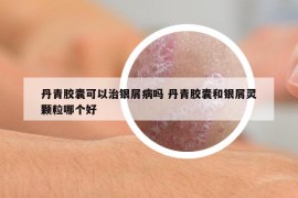 丹青胶囊可以治银屑病吗 丹青胶囊和银屑灵颗粒哪个好