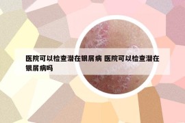 医院可以检查潜在银屑病 医院可以检查潜在银屑病吗
