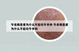 牛皮癣患者为什么不能吃牛羊肉 牛皮癣患者为什么不能吃牛羊肉