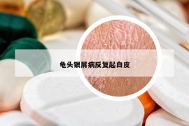 龟头银屑病反复起白皮