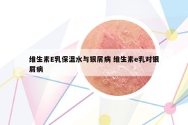 维生素E乳保温水与银屑病 维生素e乳对银屑病