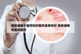 银屑病哪个医院较好医院是哪家好 银屑病哪家医院最好