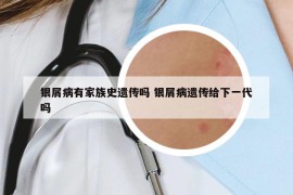 银屑病有家族史遗传吗 银屑病遗传给下一代吗