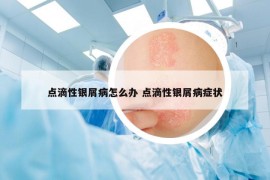 点滴性银屑病怎么办 点滴性银屑病症状