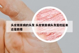 头皮银屑病的头发 头皮银屑病头发是梳起来还是散着