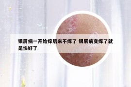 银屑病一开始痒后来不痒了 银屑病变痒了就是快好了