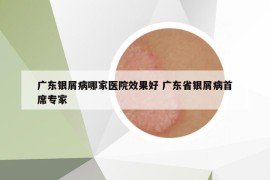 广东银屑病哪家医院效果好 广东省银屑病首席专家