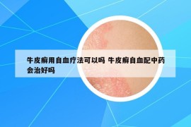 牛皮癣用自血疗法可以吗 牛皮癣自血配中药会治好吗
