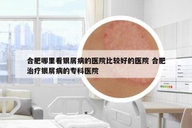合肥哪里看银屑病的医院比较好的医院 合肥治疗银屑病的专科医院
