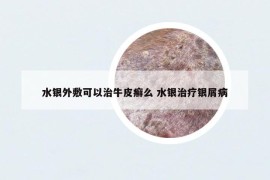 水银外敷可以治牛皮癣么 水银治疗银屑病