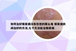 如何治好银屑病没有你想的那么难 银屑病民间治好的方法,七个方法能治银屑病