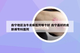 南宁地区治牛皮癣医院哪个好 南宁最好的皮肤病专科医院