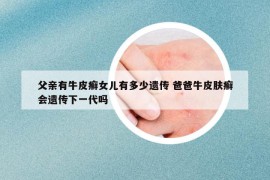 父亲有牛皮癣女儿有多少遗传 爸爸牛皮肤癣会遗传下一代吗