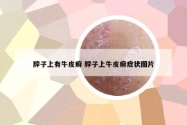 脖子上有牛皮癣 脖子上牛皮癣症状图片