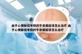 由于心情郁结导致的牛皮癣应该怎么治疗 由于心情郁结导致的牛皮癣应该怎么治疗