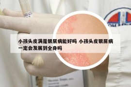 小孩头皮满是银屑病能好吗 小孩头皮银屑病一定会发展到全身吗