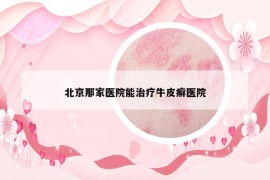 北京那家医院能治疗牛皮癣医院