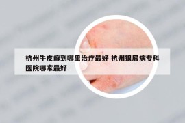 杭州牛皮癣到哪里治疗最好 杭州银屑病专科医院哪家最好