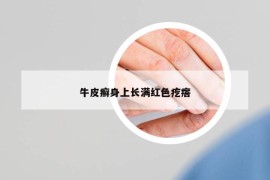 牛皮癣身上长满红色疙瘩