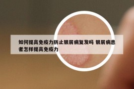 如何提高免疫力防止银屑病复发吗 银屑病患者怎样提高免疫力