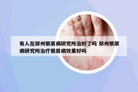 有人在郑州银屑病研究所治好了吗 郑州银屑病研究所治疗银屑病效果好吗