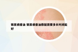 银屑病香油 银屑病香油敷腿需要多长时间能好