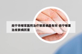 南宁市哪家医院治疗银屑病最有效 南宁哪里治皮肤病厉害